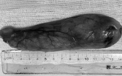 Một tháng chịu nghẹn, người phụ nữ 59 tuổi bàng hoàng khi biết thứ "đáng sợ" nằm trong cổ họng