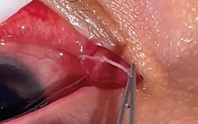 Người phụ nữ đau mắt đi khám, bác sĩ gắp ra thứ "đáng sợ" bên trong