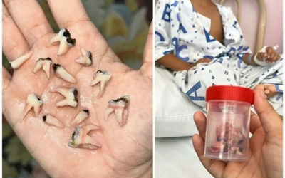 Bé trai phải nhổ 12 răng cùng lúc vì thói quen tưởng vô hại nhưng cực nguy hiểm