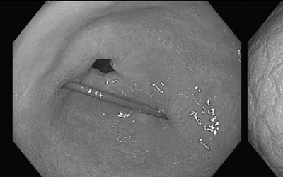 Người phụ nữ đau bụng thốc lên ngực, bác sĩ gắp ra thứ "đáng sợ"