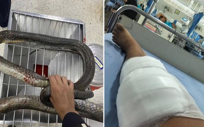 Bị rắn hổ mang cắn, người phụ nữ 47 tuổi tay không hạ gục con rắn rồi mang đến bệnh viện