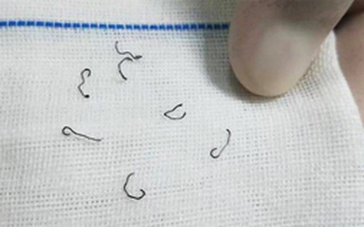Sau khi cắt trĩ, người phụ nữ phải nhập viện nhổ đinh 8 lần suốt 10 năm