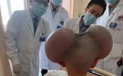 Cậu bé 3 tuổi với phần đầu lồi lên bất thường và sự thật đau lòng phía sau