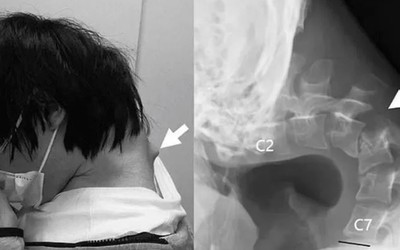 Nam thanh niên 25 tuổi không thể ngẩng đầu vì thói quen nhiều người trẻ mắc phải
