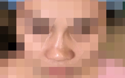 Sợ động dao kéo, nữ sinh nâng mũi bằng chỉ, 1 năm sau mũi biến dạng