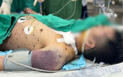 Hai nam thanh niên rơi vào nguy kịch vì biến chứng thủy đậu