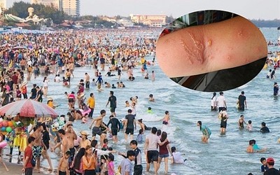 Người đàn ông bỏng rát toàn bộ chân trái sau 15 phút tắm biển