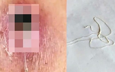 Người đàn ông 44 tuổi nhiễm loại ký sinh trùng hiếm gặp dài hàng mét