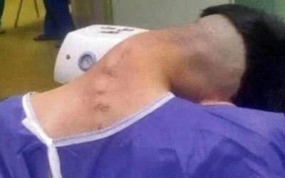 Thường xuyên làm việc này, chàng trai 23 tuổi mắc "hội chứng đầu gục"