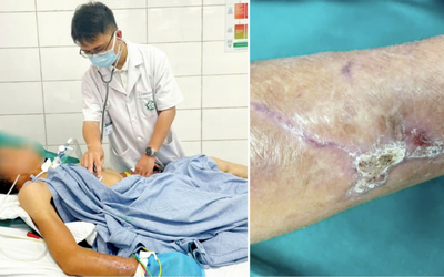 Cụ bà 90 tuổi mắc uốn ván, 5 người con tức tốc đi tiêm phòng