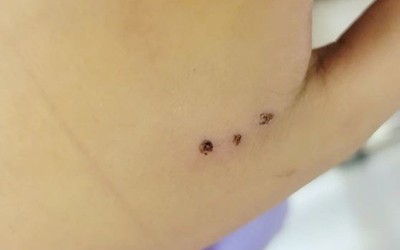 Bé 10 tuổi nhập viện sau khi bị chuột cắn