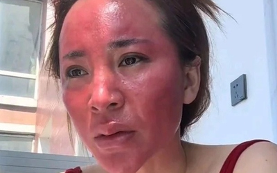 Không tẩy trang suốt 22 năm, người phụ nữ gây sốc khi mặt bị biến dạng