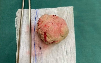 Cụ ông 98 tuổi có sỏi bàng quang "khủng" như quả trứng gà