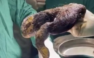 Bé gái 14 tuổi đau bụng, nôn mửa suốt 1 tháng, khi phẫu thuật bác sĩ lấy ra thứ không ngờ