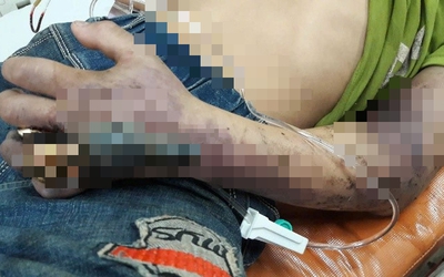 Bị rắn độc cắn, người đàn ông 50 tuổi tin thầy lang đắp thuốc lá "rước họa vào thân"