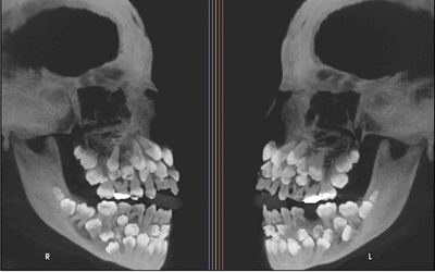 Đi nhổ răng sữa, bé gái khiến nha sĩ sốc nặng khi có 81 chiếc răng