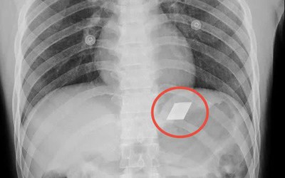 Khám cho nam thanh niên 26 tuổi, bác sĩ phát hiện thứ không ai ngờ
