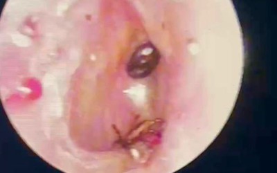 Nội soi tai bé trai 9 tuổi, bác sĩ phát hiện điều đáng sợ