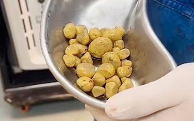 Phát hiện 35 viên sỏi trong bàng quang người đàn ông, "thủ phạm" là loại nước quen thuộc