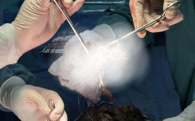 Bé gái đau bụng dữ dội, đi khám, bác sĩ sốc nặng khi thấy thứ bên trong