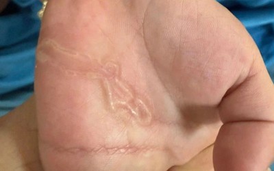 Bàn tay bé trai xuất hiện dấu hiệu lạ, đi khám, bác sĩ phát hiện "bí mật đáng sợ"