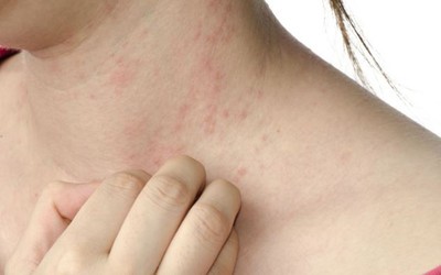 Đi khám vì bị ngứa khắp người, người phụ nữ sốc nặng trước thông báo của bác sĩ