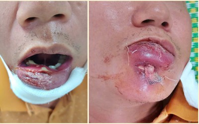 Người đàn ông 40 tuổi nhập viện với phần môi sưng tấy vì mắc sai lầm phổ biến