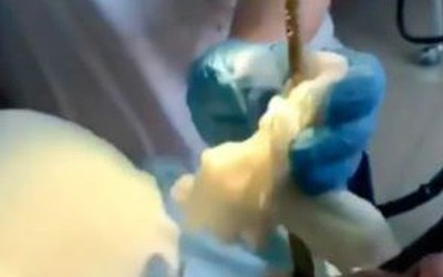 Đang ngủ ngoài sân, người phụ nữ sốc nặng khi bị con rắn 1,2m chui vào miệng