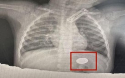 Đưa con trai đi điều trị viêm phổi, cha mẹ sốc nặng khi bác sĩ gắp ra thứ "đáng sợ" trong dạ dày