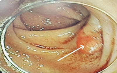 Bất ngờ "thủ phạm" khiến người phụ nữ 58 tuổi đau bụng kéo dài