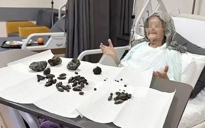Khám bụng cụ bà 92 tuổi, bác sĩ sốc nặng khi thấy thứ bên trong