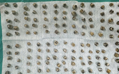 Người phụ nữ 40 tuổi đau bụng, buồn nôn, bác sĩ sốc nặng khi phát hiện "bí mật đáng sợ"