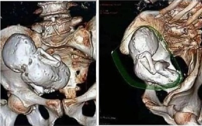 Chụp CT cho cụ bà 73 tuổi, bác sĩ sốc nặng khi phát hiện thai nhi hóa đá 30 năm