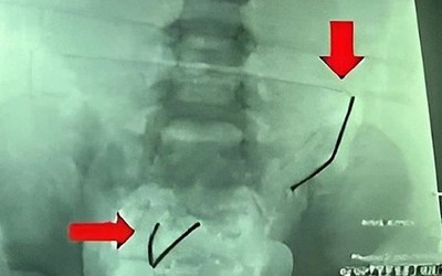 Bé trai 5 tuổi đau bụng, nôn ói, gia đình đưa đi kiểm tra thì sốc nặng