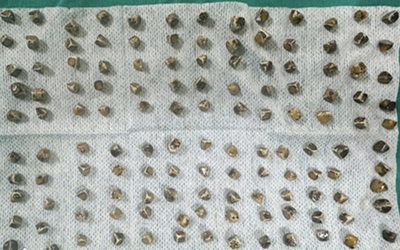 Đau bụng đi khám, người phụ nữ 40 tuổi sốc khi bác sĩ gắp ra thứ "đáng sợ" bên trong