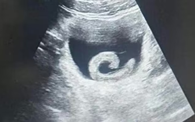 Đi siêu âm, người đàn ông sốc nặng khi thấy con vật "bơi" trong bụng mình