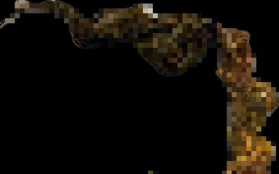 Bé gái 9 tuổi có thói quen lạ đời, bác sĩ gắp ra thứ "đáng sợ" trong bụng