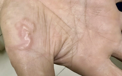 Thường xuyên ăn món "vạn người mê", cô gái trẻ sốc khi biết nhiễm 4 loại ký sinh trùng