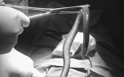 Bụng "cứng như gỗ", người đàn ông sốc nặng khi biết có con vật bơi trong bụng mình