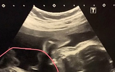 Đi khám thai, người phụ nữ 32 tuổi sốc nặng khi thấy kết quả siêu âm