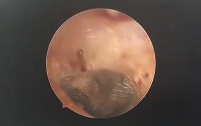 Nghe thấy âm thanh lạ trong tai, người phụ nữ đi khám thì sốc nặng