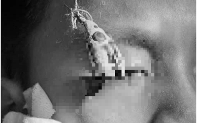 Bé trai 12 tuổi đau mắt dữ dội, bác sĩ gắp ra thứ "đáng sợ" bên trong