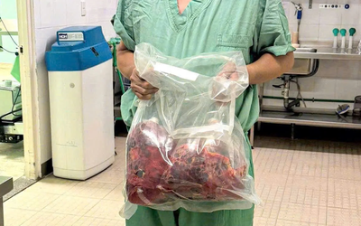 Lần đầu tiên tại Việt Nam: Cắt bỏ hai thận đa nang nặng gần 10kg, ghép thận thành công trong một ca mổ