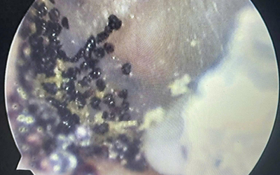 Nghe thấy âm thanh lạ trong tai, bé 7 tuổi đi khám thì sốc nặng