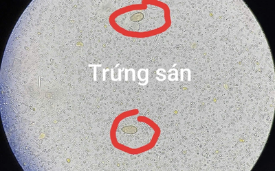 Đau bụng đi khám, người đàn ông 64 tuổi sốc ngang khi thấy ở sán trong người