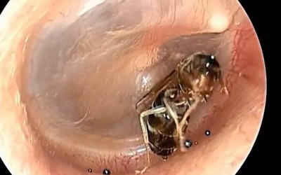 Đi khám, bác sĩ sốc nặng khi thấy thứ bên trong tai người đàn ông