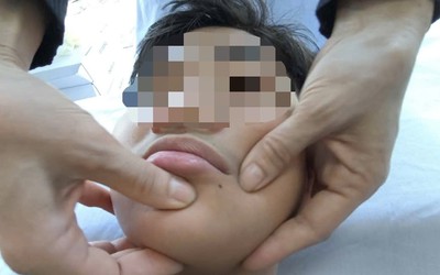 Miền Bắc rét sâu, gia tăng số người bị méo miệng: Chuyên gia chỉ cách bảo vệ sức khỏe "vàng"