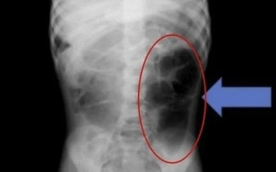 Bé gái đau bụng đi khám, bác sĩ lấy thứ "đáng sợ" bên trong