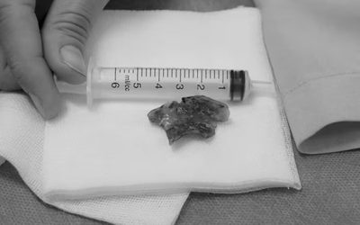 Nửa đêm đau họng, người phụ nữ 55 tuổi phát hiện bí mật "đáng sợ"