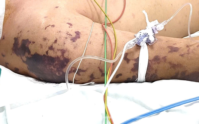 Ăn thịt lợn ở đám cỗ, người đàn ông 52 tuổi lơ mơ, nguy kịch